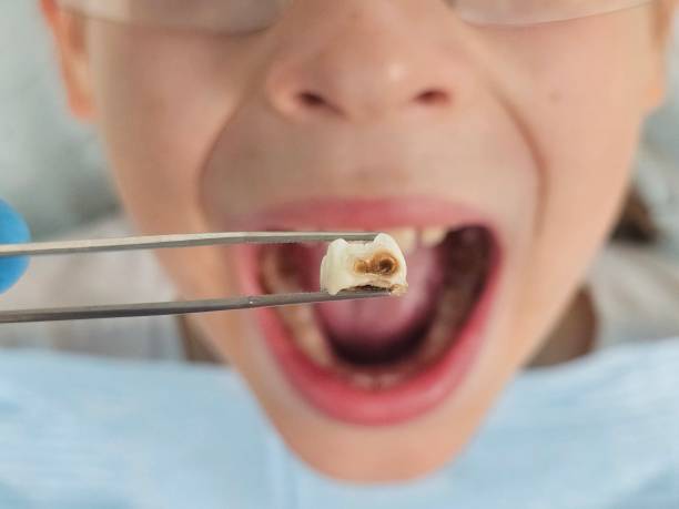 Best Emergency Treatment for Dental Infections or Abscesses in Wanakah, NY